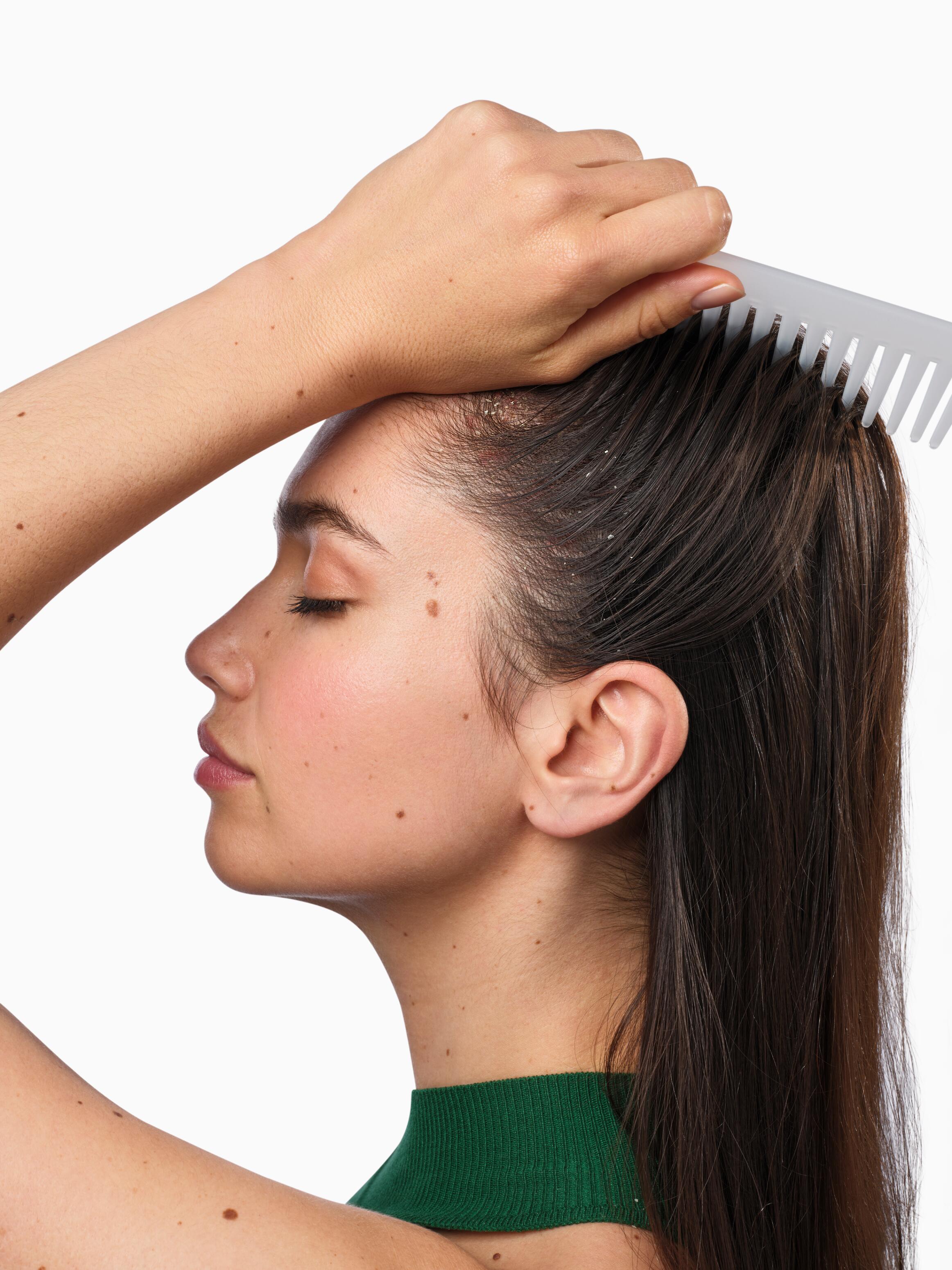 Caspa grasa: purifica y regula la producción de sebo.